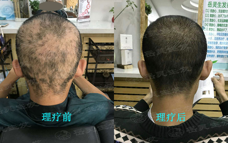 中年男人防脱生发的养发护发事项