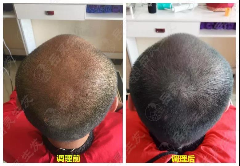 岳灵生发脱发再生实例