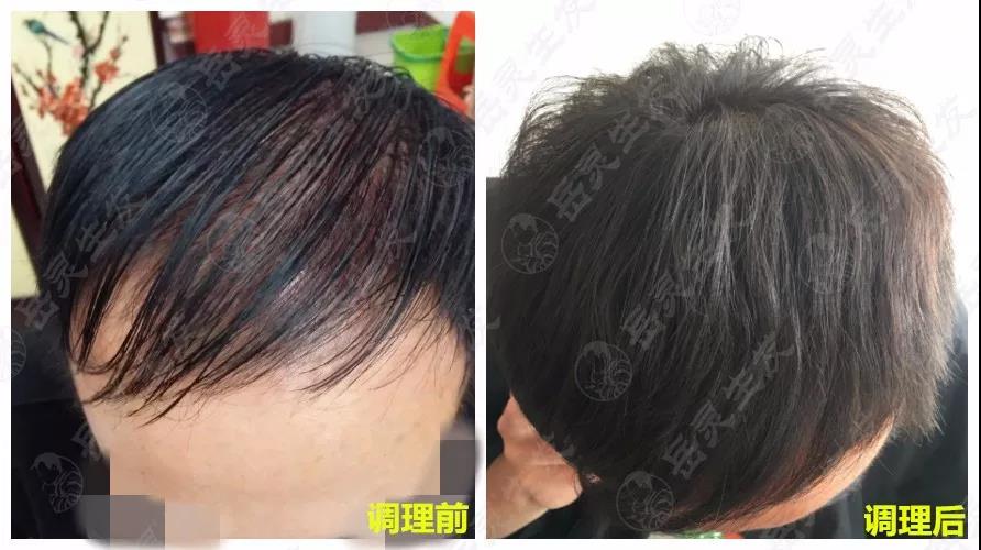 岳灵生发脱发再生对比