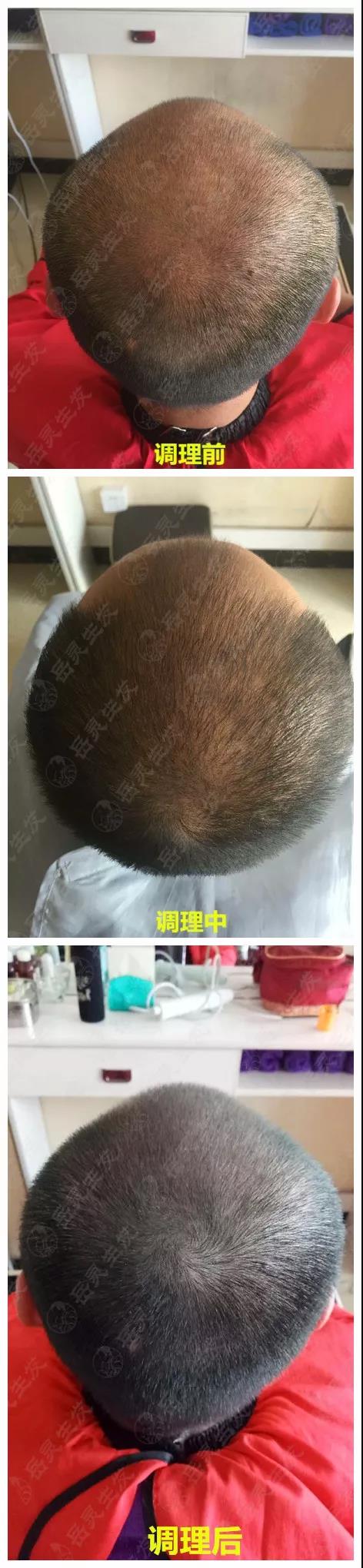 岳灵生发脱发再生实例