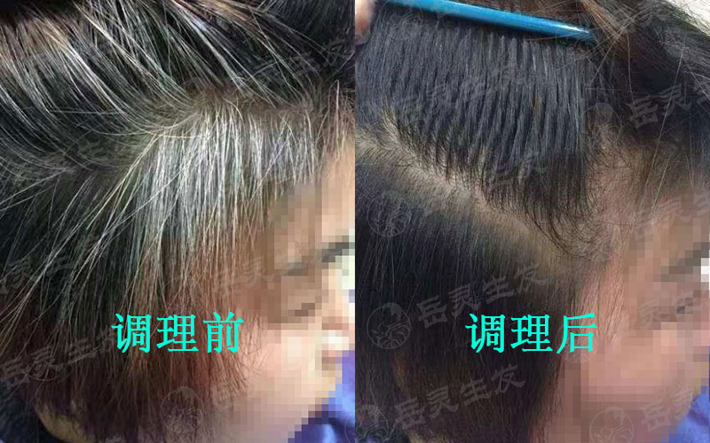 白头发出现的原因及如何预防白发