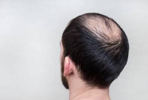 男性如何养发来预防脱发和掉头发