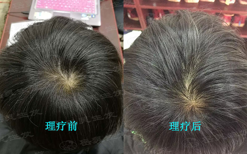 白发的病因有哪些?