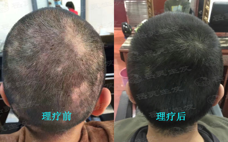 防脱生发男女有不同的生发养发方法